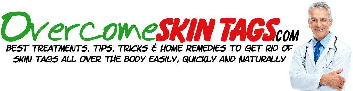 Treatments, Tips, Tricks And Home Remedies To Get Rid Of Skin Tags Fast